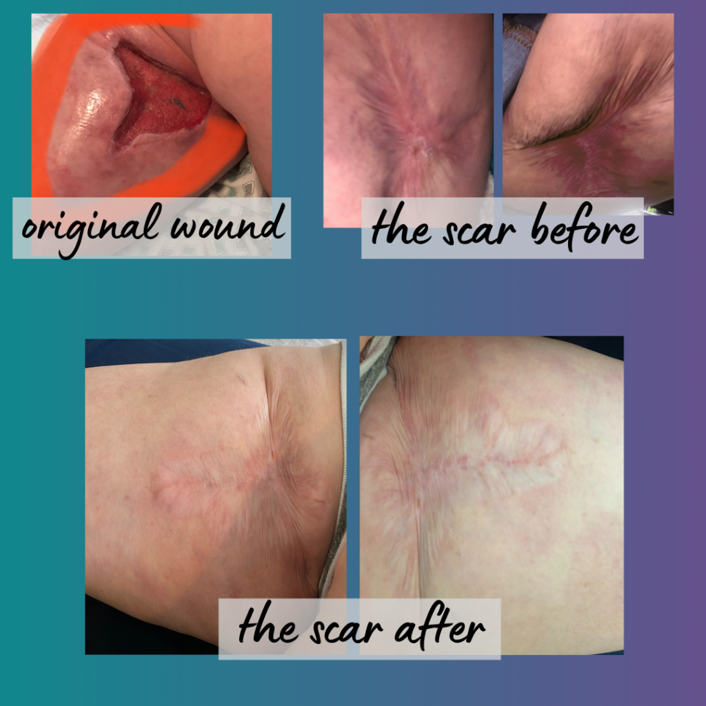 scar tissue before and after release therapy