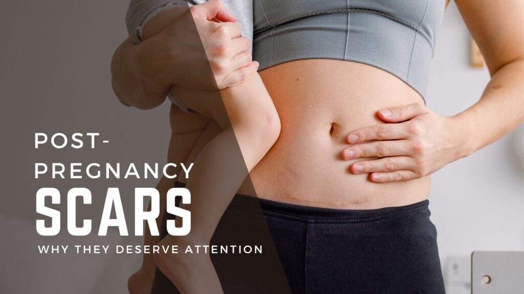 why post-pregnancy scars deserve attention